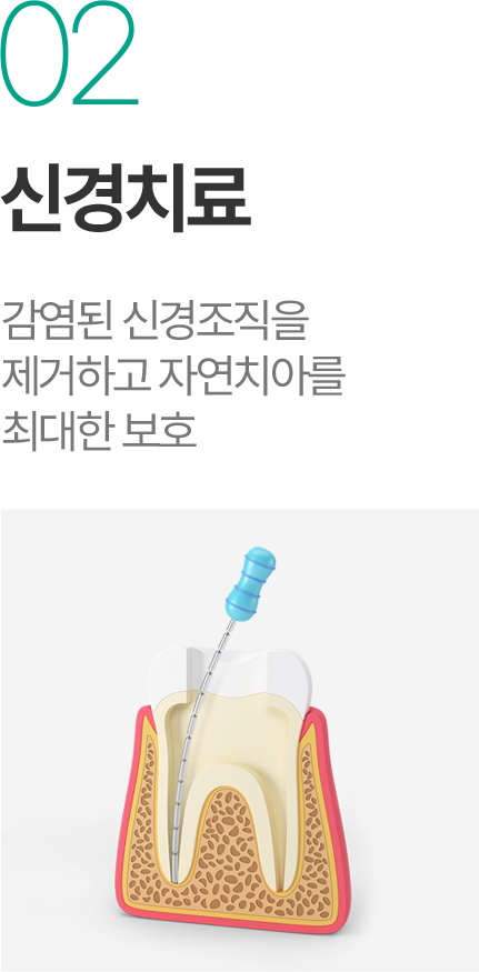 신경치료 - 감염된 신경조직 제거와 자연치아 보호