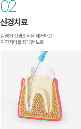 신경치료 - 감염된 신경조직 제거와 자연치아 보호