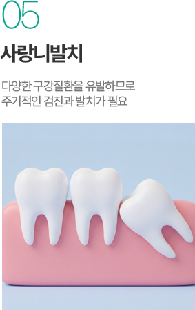 사랑니발치 - 구강질환 예방을 위한 검진과 발치